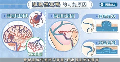 聽到水流聲|神經外科醫師圖文解說：吵到睡不著！「脈動性耳鳴」。